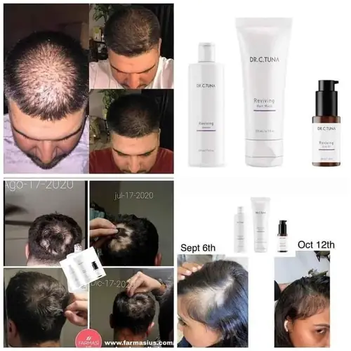 Reviving Hair Dr. C. Tuna - Antes y después crecimiento capilar
